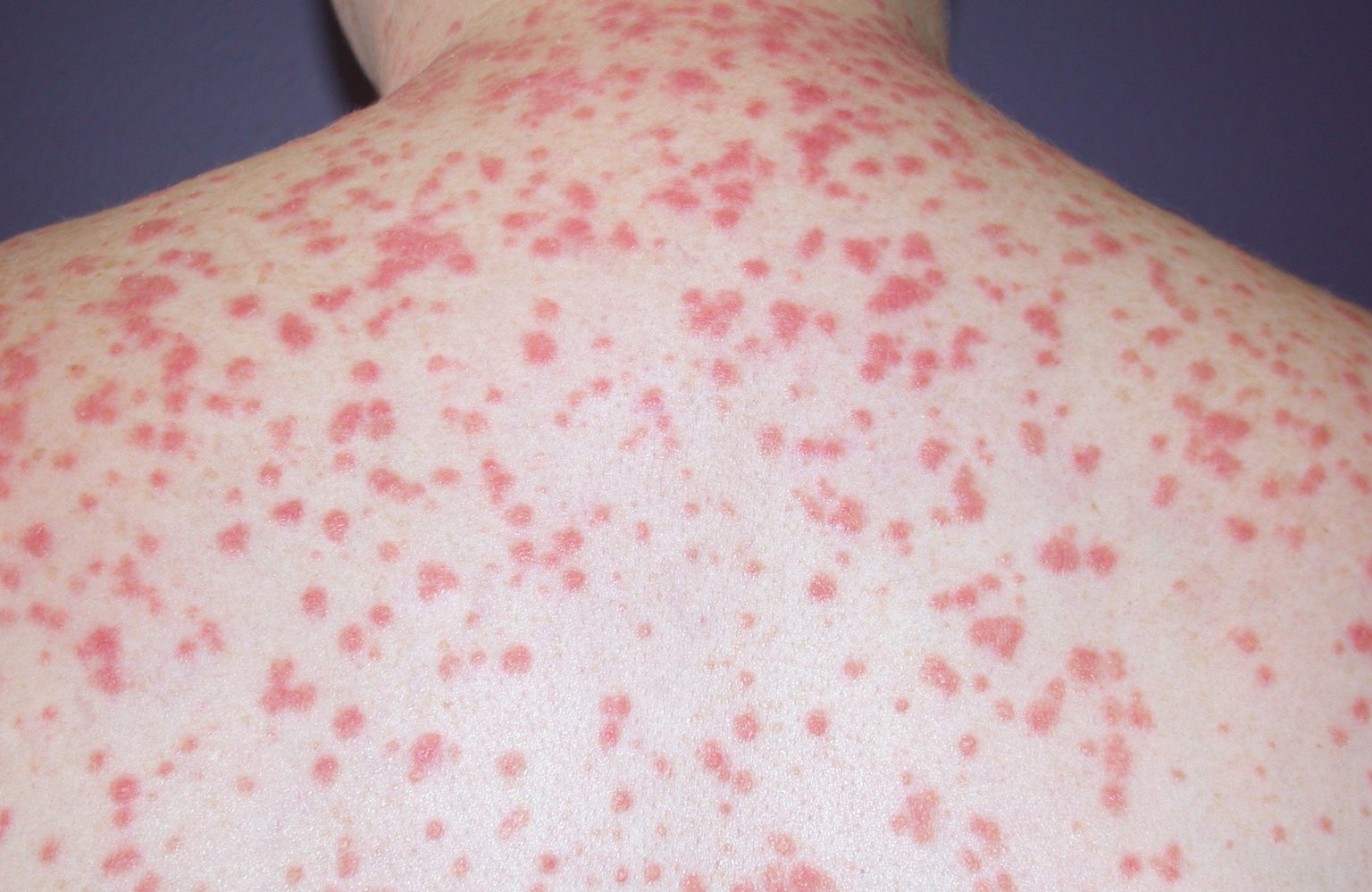 Psoriasis Causes Triggers Diagnosis And Treatment 