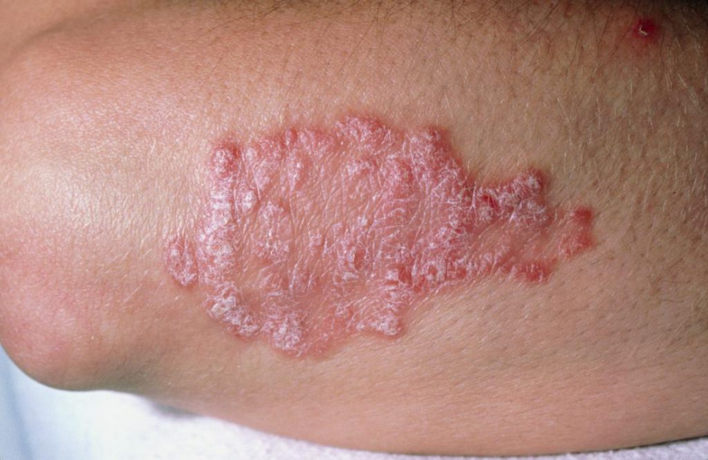 Psoriasis | Causes, Triggers, Diagnosis & Treatment