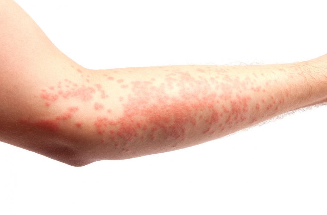 This skin rash is back after almost vanishing during the pandemic