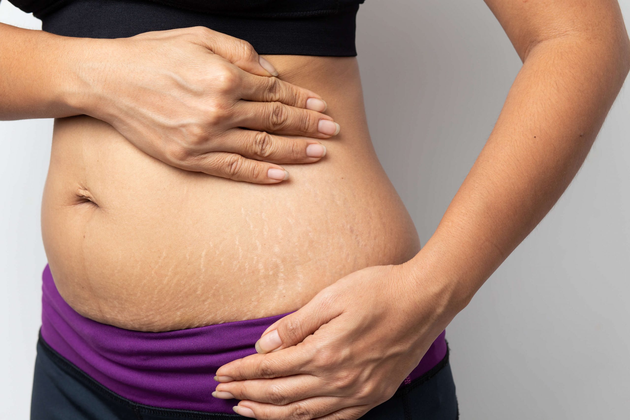 Stretch Marks & Weight Loss: Everything You Need To Know - SOG