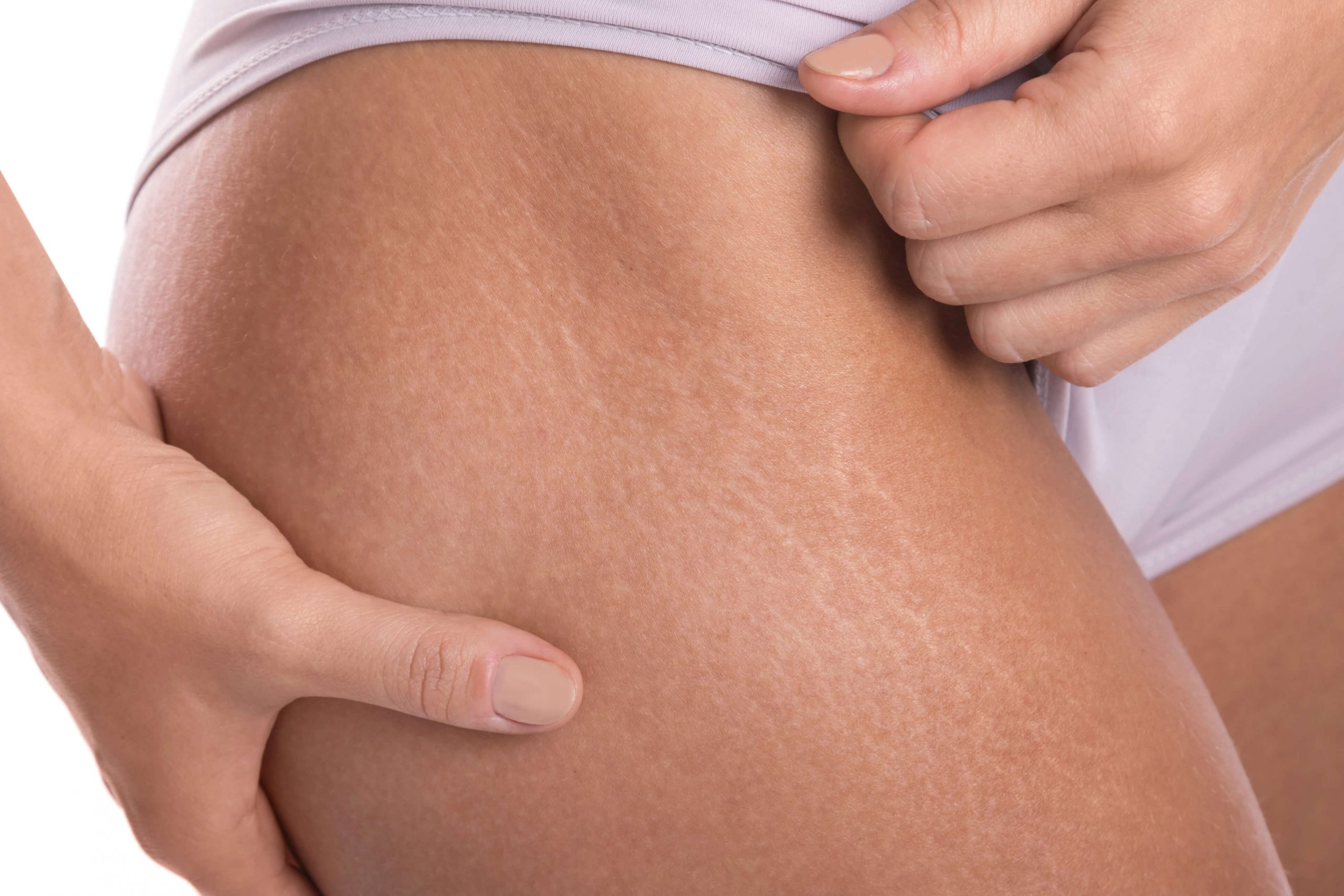 Reduce Stretch Marks Caused During Pregnancy