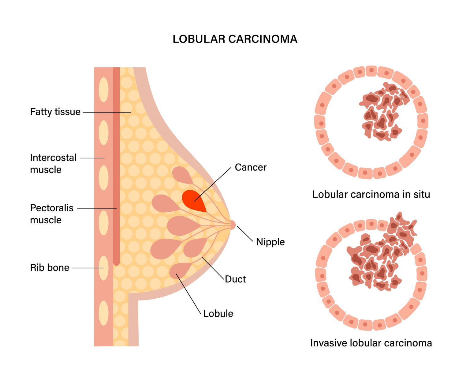 breast-cancer-prevention-risk-factors-and-how-one-can-lower-her-risks